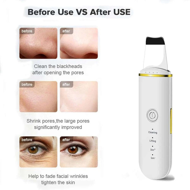 Épurateur de peau ultrasons Beautysky montrant les résultats avant et après utilisation pour le nettoyage des pores