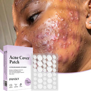 Patch anti-acné 72 pièces de Beautysky pour réduire les imperfections et apaiser la peau