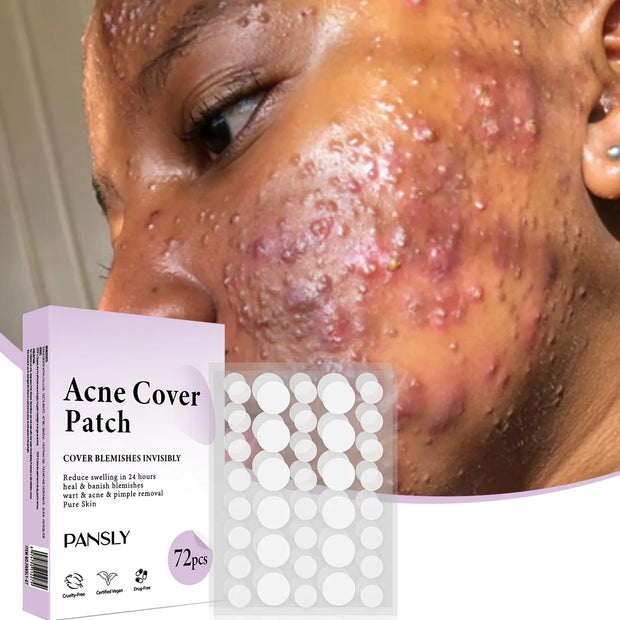Patch anti-acné 72 pièces de Beautysky pour réduire les imperfections et apaiser la peau